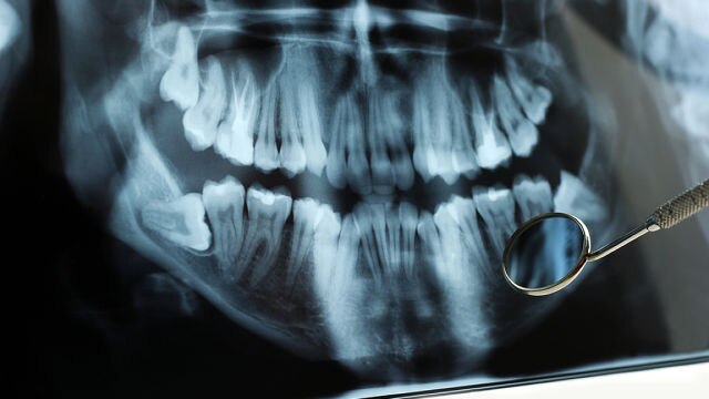 Conseils importants pour mieux cicatriser après l'extraction de dents de sagesse